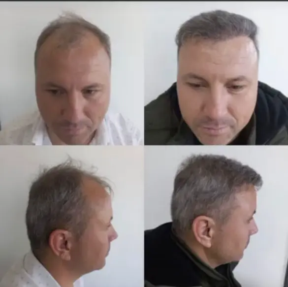 Before and after hair transplant result 15