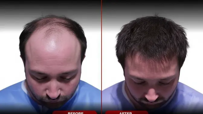 Hair Transplant