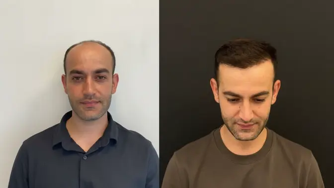 Before and after hair transplant result 12