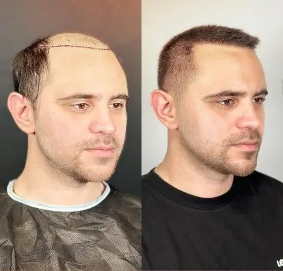 Avoiding common mistakes during hair transplant recovery process Avoiding common mistakes during hair transplant recovery process