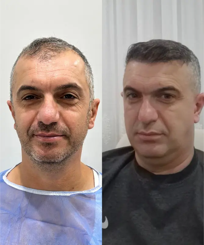 Before and after hair transplant result 26