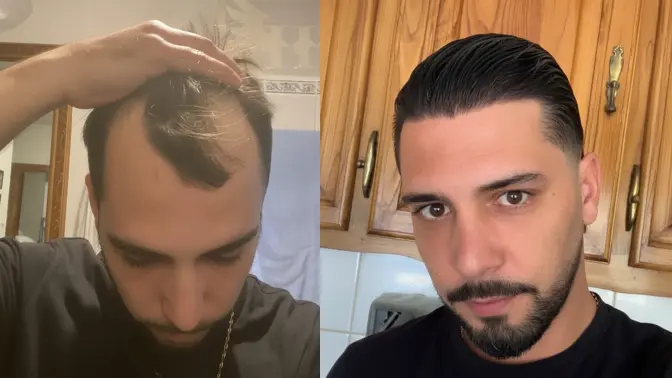 Before and after hair transplant result 8
