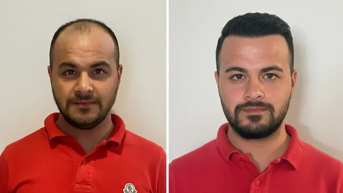 Before and after hair transplant result 9